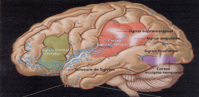 Figure N° 3. L’apparition des ectopies (hétérotopie) au niveau du cerveau dyslexique